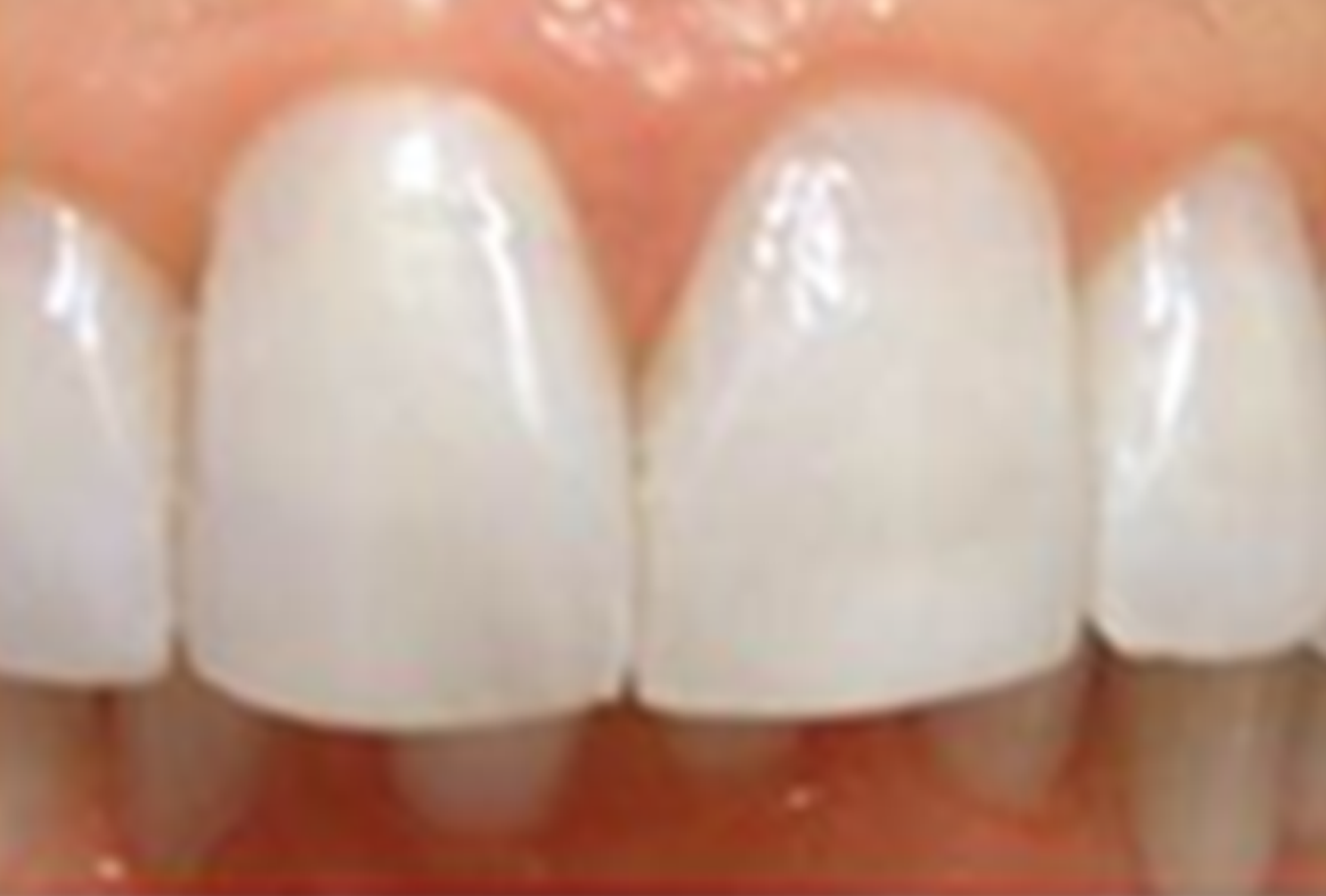 after fast braces treatment