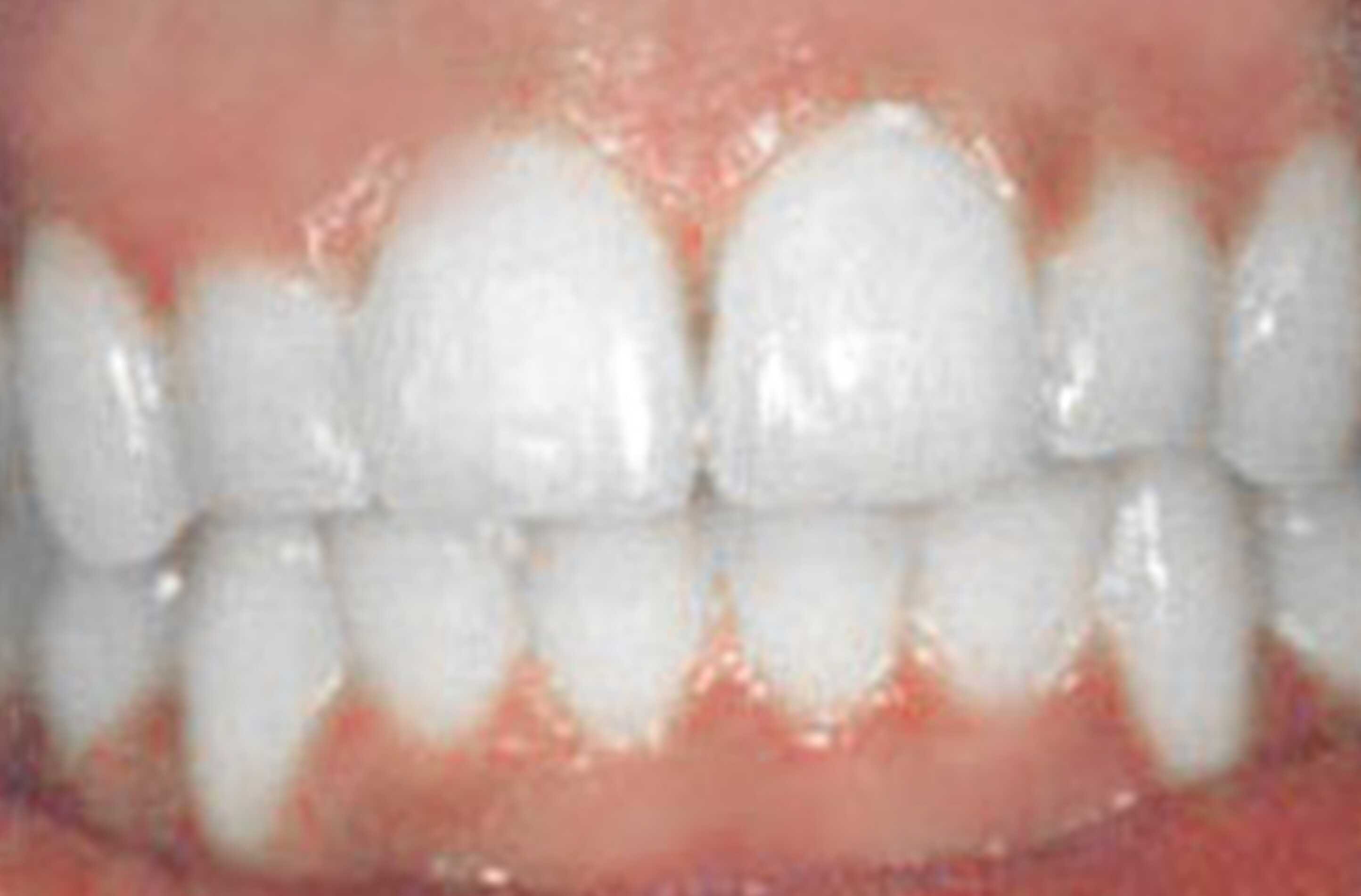 after fast braces treatment
