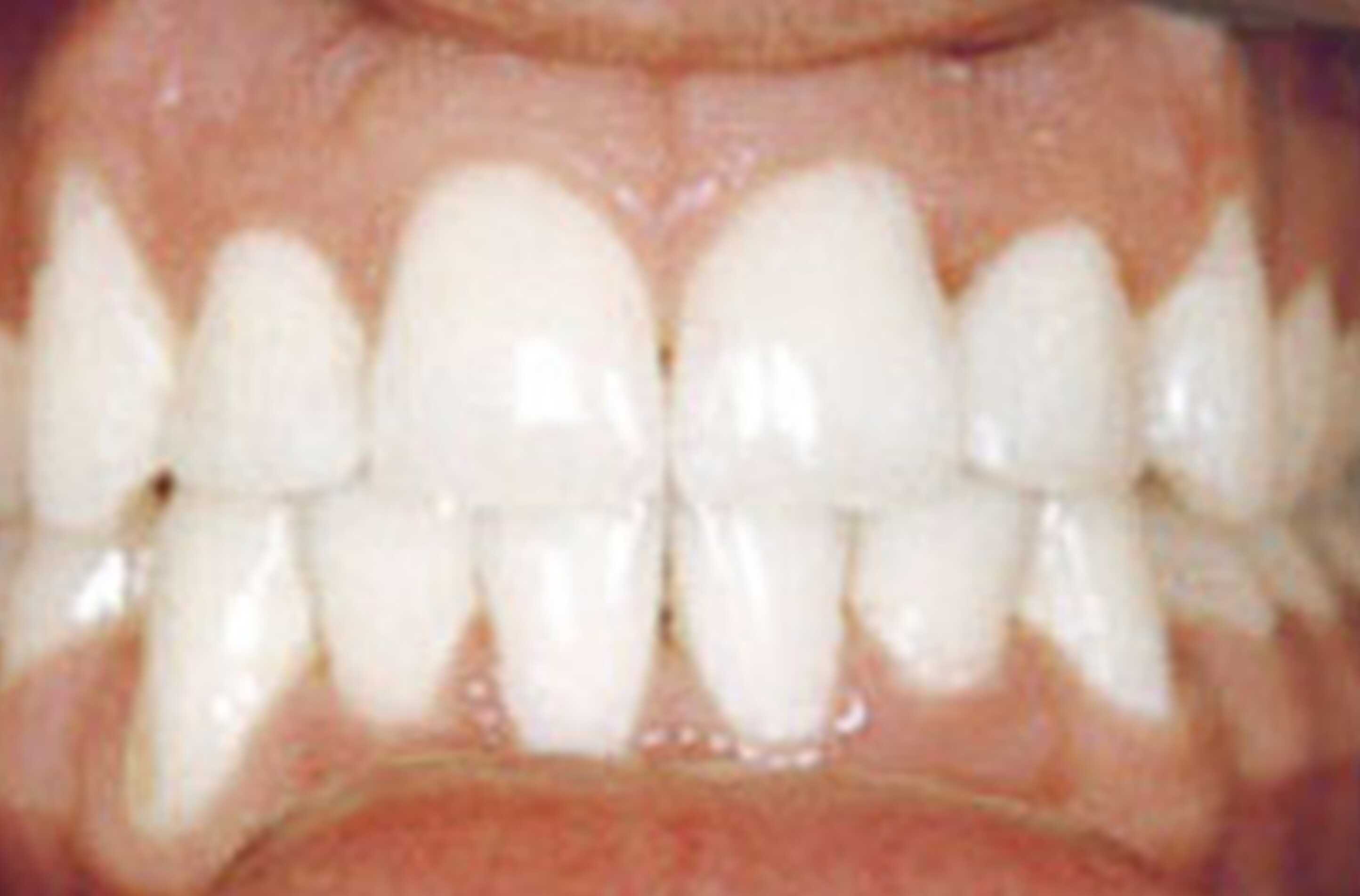 after fast braces treatment