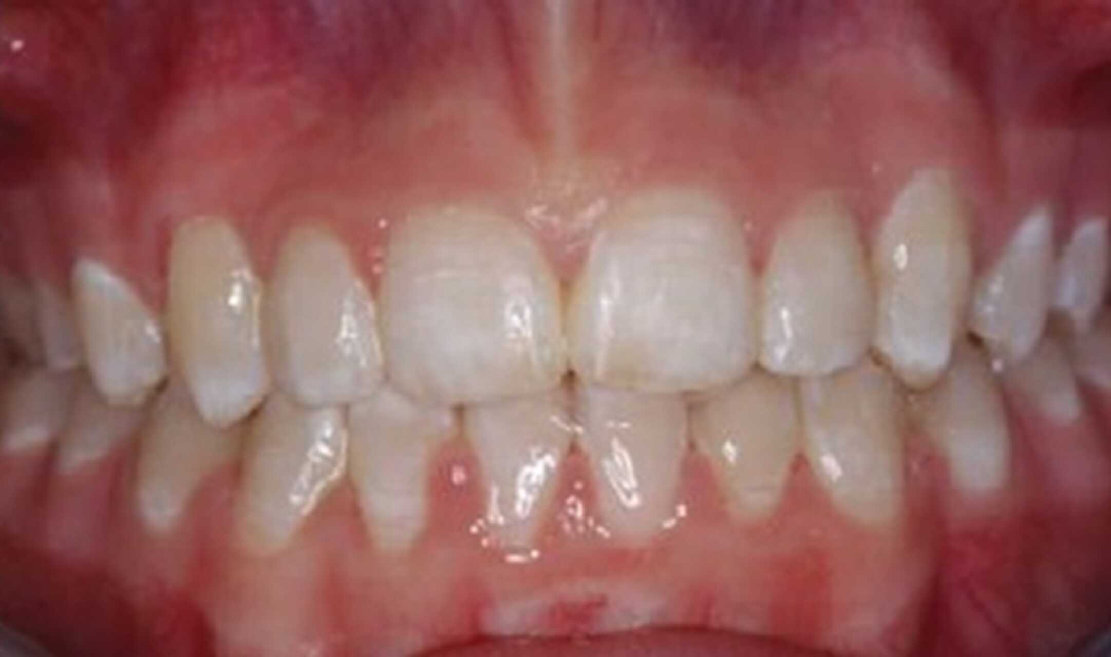 after fast braces treatment